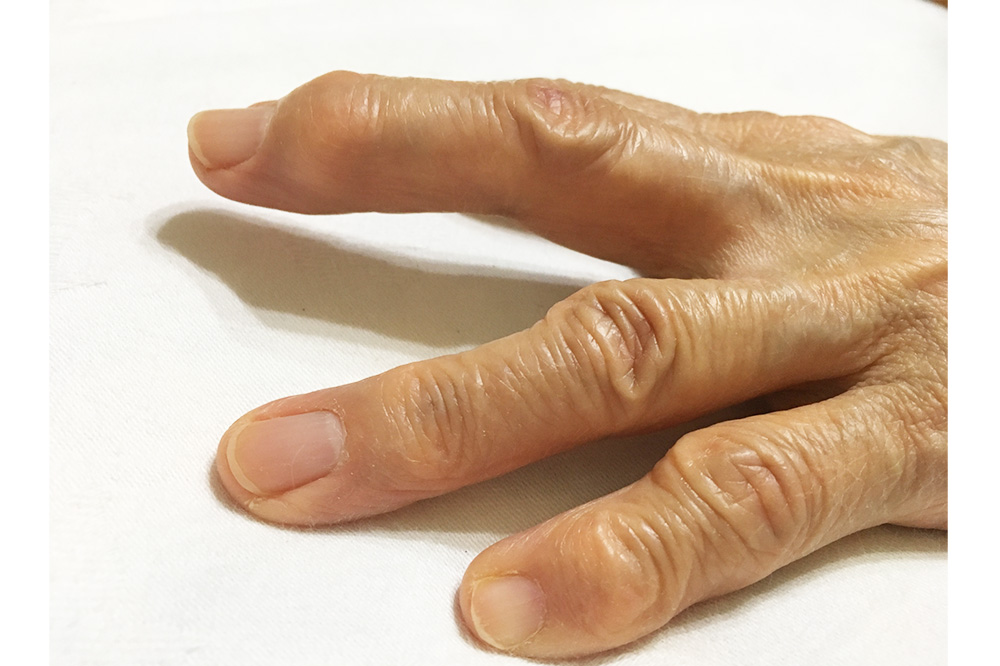 40代以降の女性に多い指の変形「へバーデン・ブシャール結節」の原因と治療法